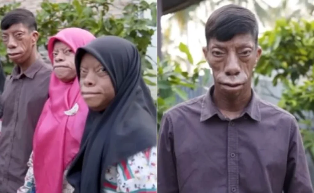 हर दिन बदल जाता है चेहरा! इंडोनेशिया के मुरांग परिवार का रहस्यमयी मामला