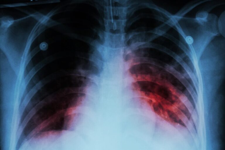 Silent Tuberculosis: चुपचाप फैल रही ‘साइलेंट टीबी’! पूर्वोत्तर में 14 हजार से ज्यादा मरीजों में नहीं दिखे कोई लक्षण