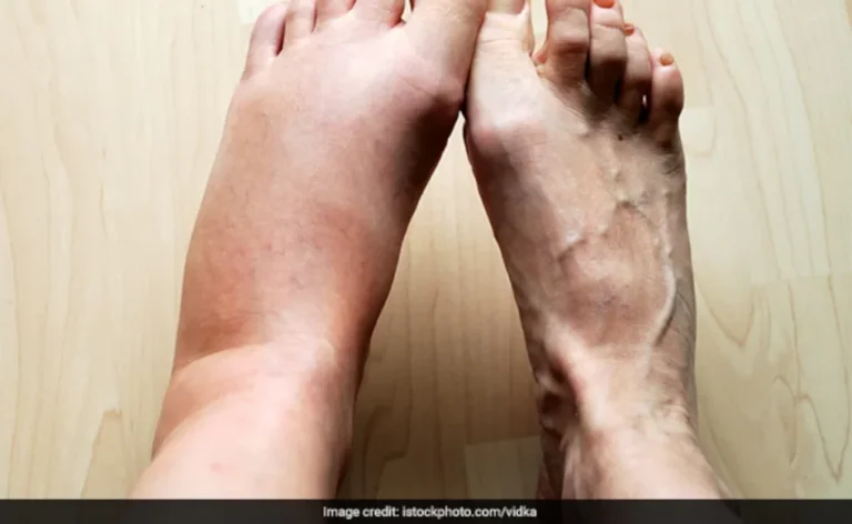 Foot Swelling : बार-बार पैरों में सूजन को न करें नजरअंदाज, हार्ट-किडनी समेत इन गंभीर बीमारियों का हो सकता है संकेत